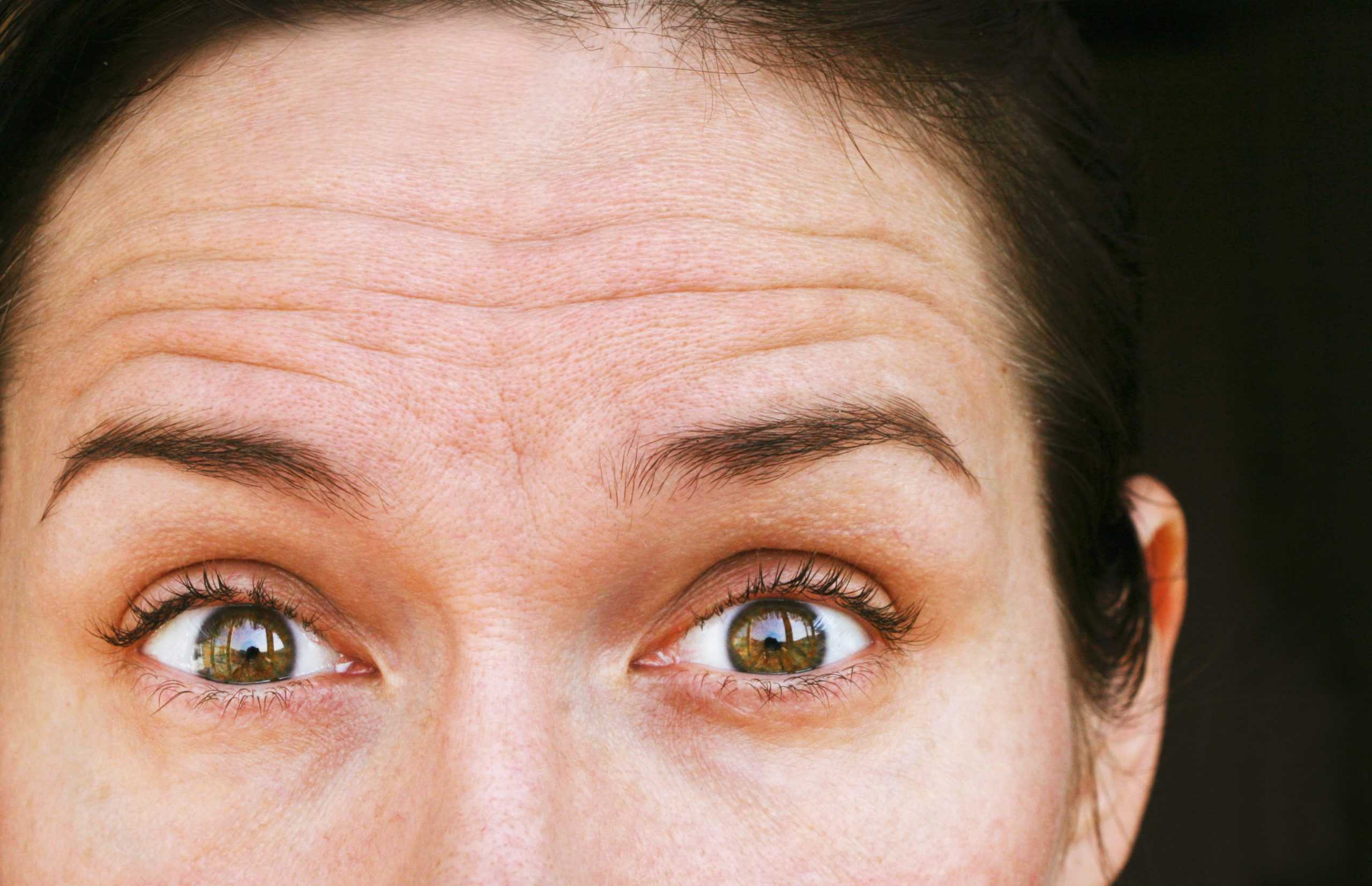 How Does Botox Work for Wrinkles
