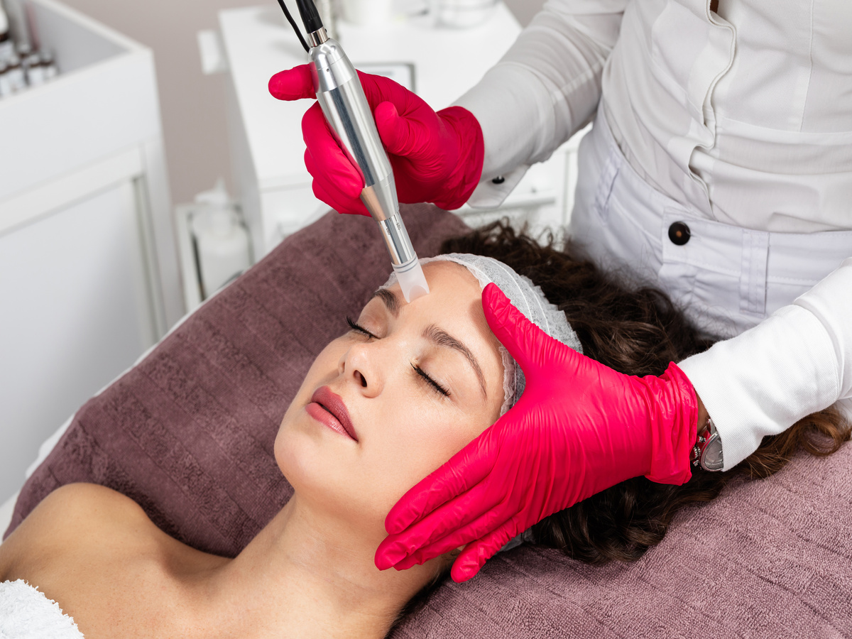 Microneedling-By-The-Beauty-Bar-in-Bettendorf-IA